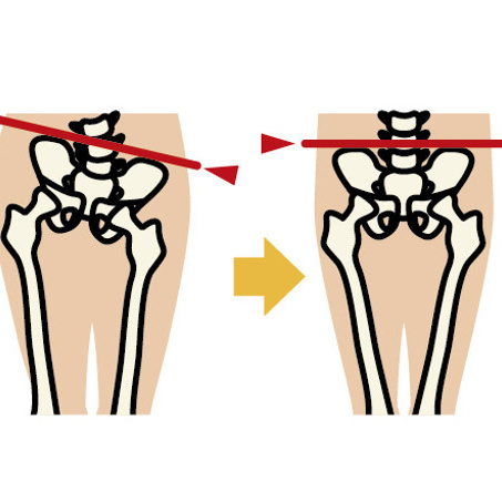 骨盤の歪み